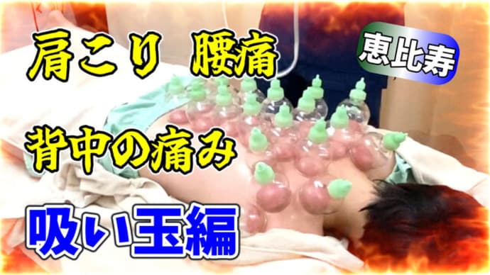 【恵比寿吸い玉】肩こり腰痛背中の痛みを何とかして欲しい!カッピング【渋谷区恵比寿・鍼灸院・整体】コスモ治療院(リメイク)